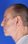 after Facelift Case male patient side view Case 1553