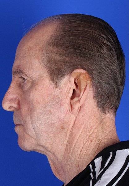 before Facelift Case male patient side view Case 1553