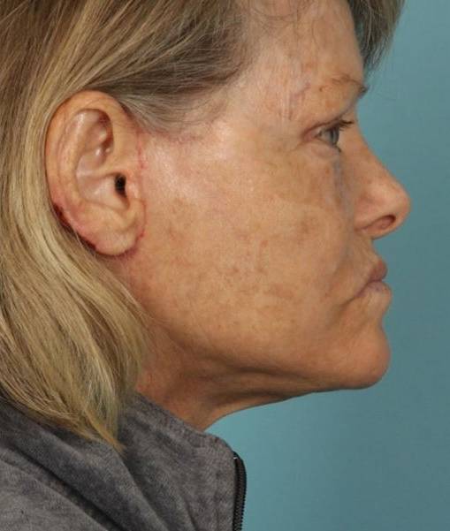 after Facelift Case female patient side view Case 1560