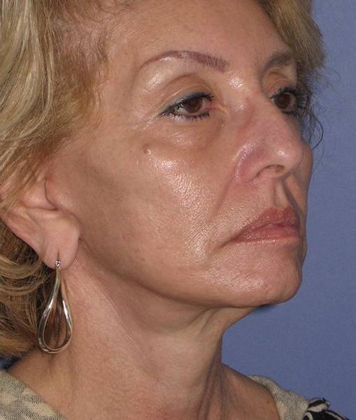 after Facelift female patient diagonal angle view Case 1567