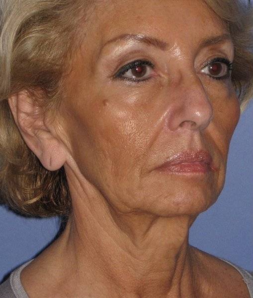 before Facelift female patient diagonal angle view Case 1567