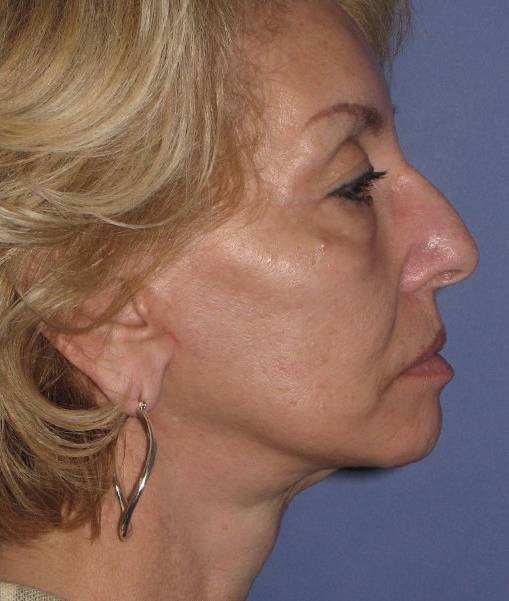 after Facelift female patient side angle view Case 1567