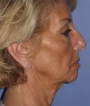 before Facelift female patient side angle view Case 1567