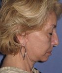 after Facelift female patient side angle view looking downwards Case 1567