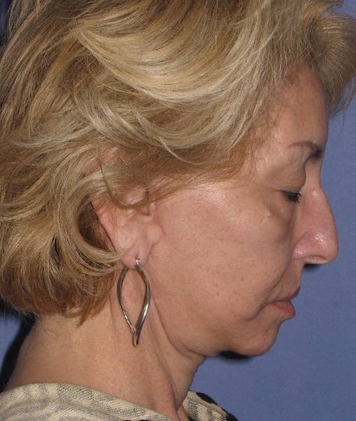 after Facelift female patient side angle view looking downwards Case 1567