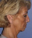 before Facelift female patient side angle view looking downwards Case 1567