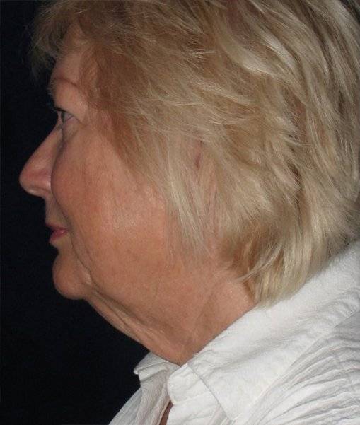 Patient Facelift Before 2