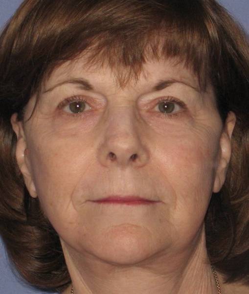 after Facelift female patient front angle view Case 1584