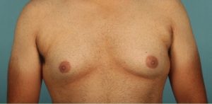 before gynecomastia front view of male patient 653 at Paydar Plastic Surgery