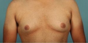 Patient Gynecomastia Before 0