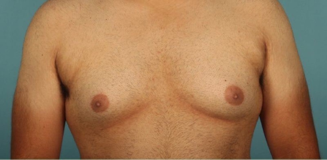 before gynecomastia front view of male patient 653 at Paydar Plastic Surgery