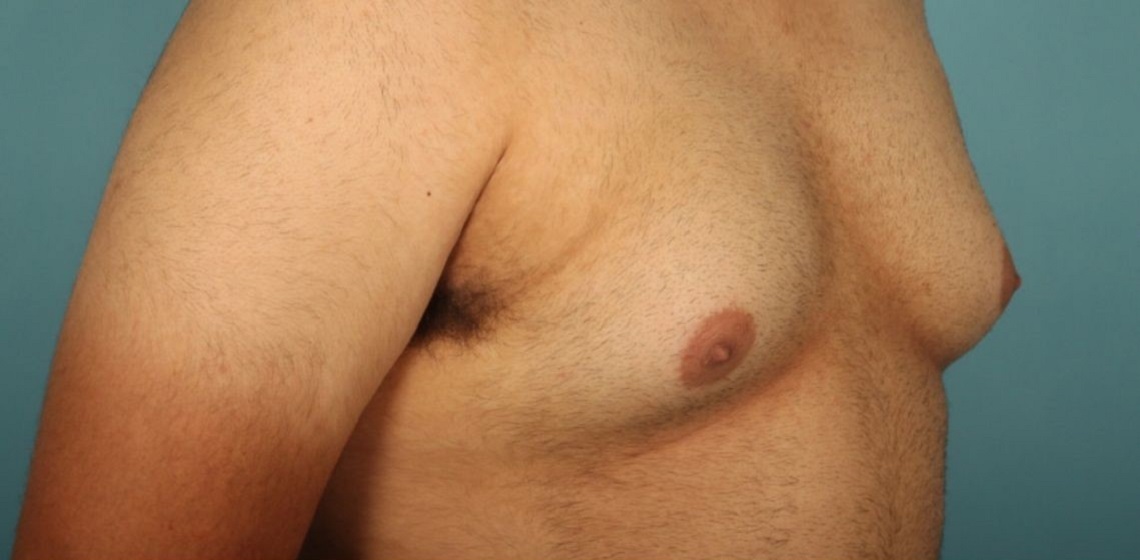 before gynecomastia right angle view of male patient 653 at Paydar Plastic Surgery