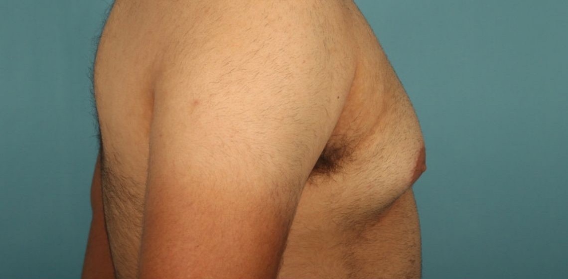 before gynecomastia right view of male patient 653 at Paydar Plastic Surgery
