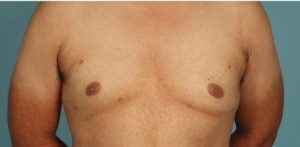 after gynecomastia front view of male patient 653 at Paydar Plastic Surgery