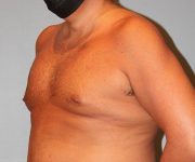 before gynecomastia left angle view of male patient 661 at Paydar Plastic Surgery