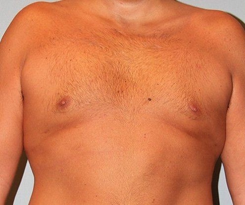 before gynecomastia front view of male patient 661 at Paydar Plastic Surgery