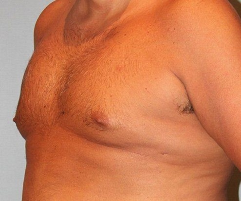 before gynecomastia left angle view of male patient 661 at Paydar Plastic Surgery