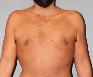 after gynecomastia front view of male patient 661 at Paydar Plastic Surgery