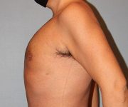 after gynecomastia left view of male patient 661 at Paydar Plastic Surgery