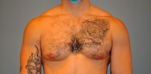 Patient Gynecomastia Thumbnail Before 0