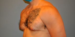 before gynecomastia left angle view of male patient 673 at Paydar Plastic Surgery