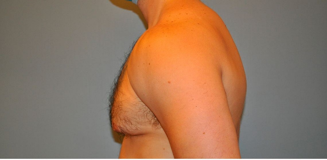 before gynecomastia left view of male patient 673 at Paydar Plastic Surgery
