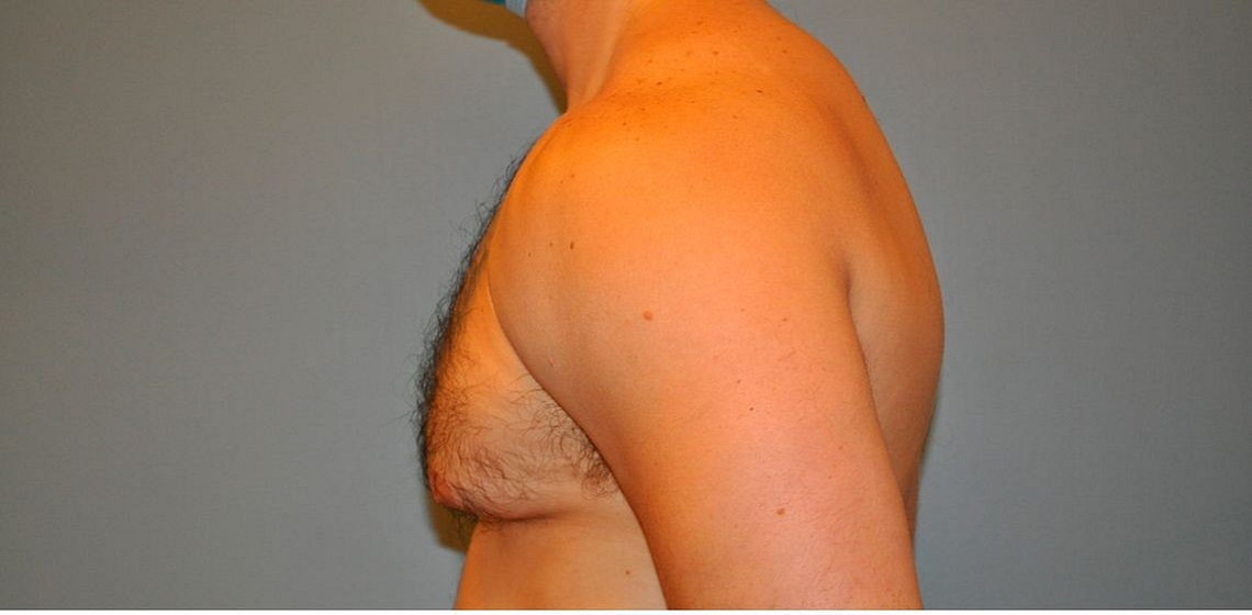 Patient Gynecomastia Before 2