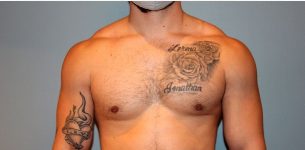 after gynecomastia front view of male patient 673 at Paydar Plastic Surgery