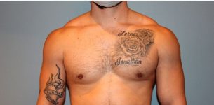 Patient Gynecomastia Thumbnail After 0