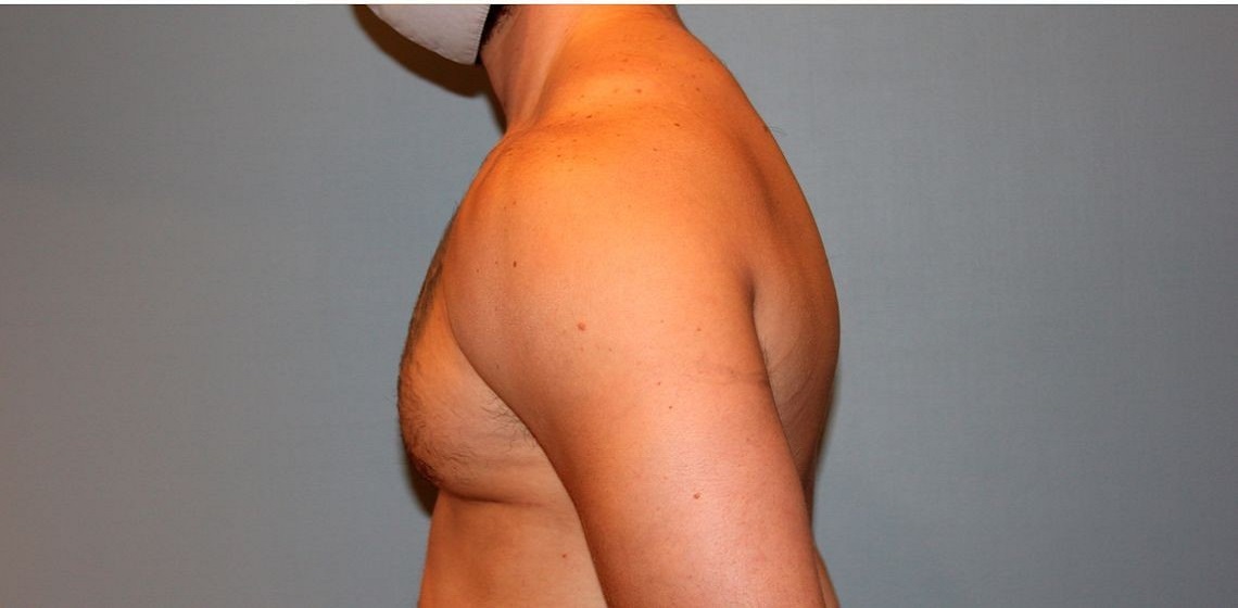 after gynecomastia left view of male patient 673 at Paydar Plastic Surgery