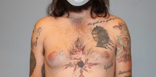before gynecomastia front view of male patient 680 at Paydar Plastic Surgery
