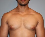 Patient Gynecomastia Thumbnail Before 0