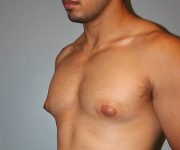 Patient Gynecomastia Thumbnail Before 1