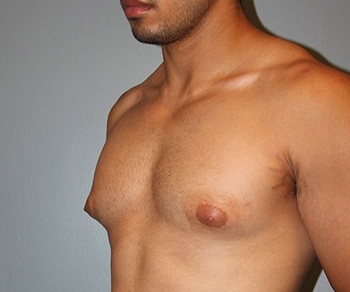 before gynecomastia left angle view of male patient 688 at Paydar Plastic Surgery