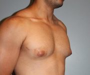 Patient Gynecomastia Thumbnail Before 2