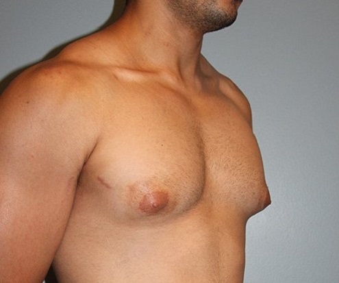before gynecomastia right angle view of male patient 688 at Paydar Plastic Surgery