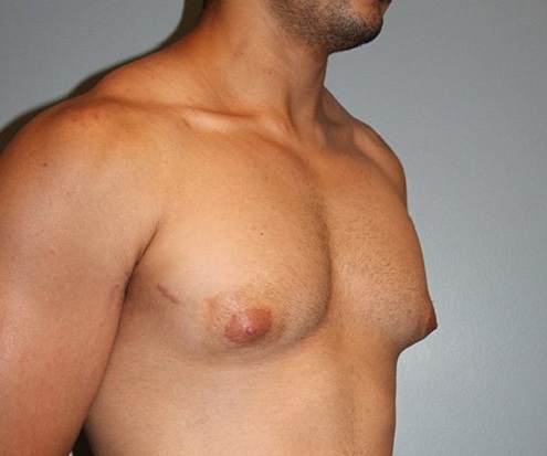 Patient Gynecomastia Before 2