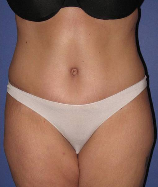 after liposuction front view female case 1002