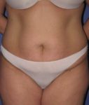 before liposuction front view female case 1002