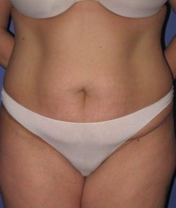 Patient Liposuction Before 0