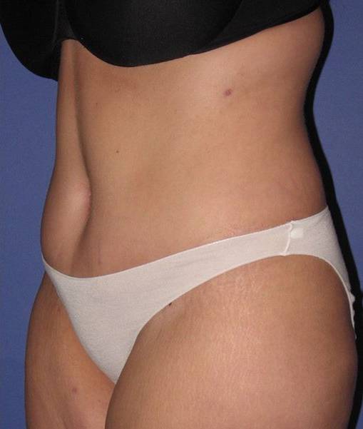 after liposuction angle view female case 1002