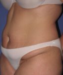 Patient Liposuction Thumbnail Before 1