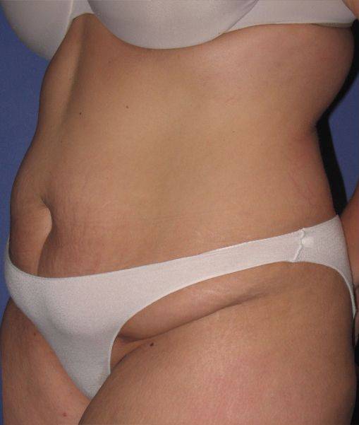before liposuction angle view female case 1002