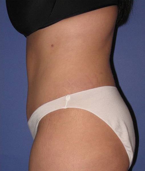 after liposuction side view female case 1002