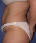 before liposuction side view female case 1002