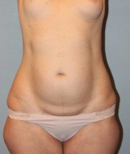 Patient Liposuction Before 0