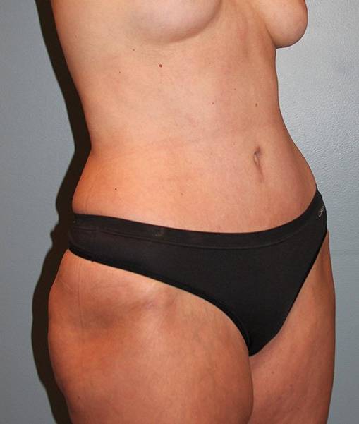 Patient Liposuction Before 1