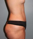 after liposuction side view female case 1035