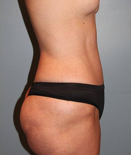after liposuction side view female case 1035
