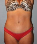 Patient Liposuction Thumbnail After 0